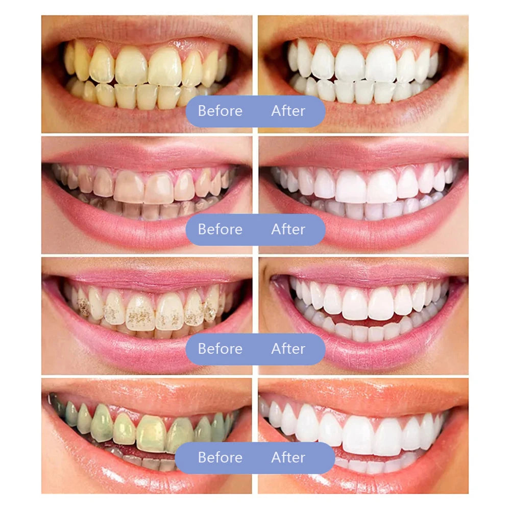 Kit LED Blanqueador Dental Portátil